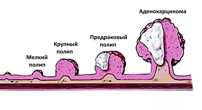 Полип как выглядит фото Проявления и лечение полипа в пищеводе