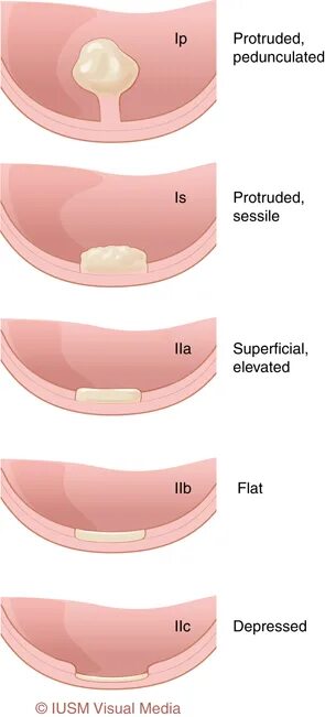 Полип как выглядит фото Paris classification. Download Scientific Diagram