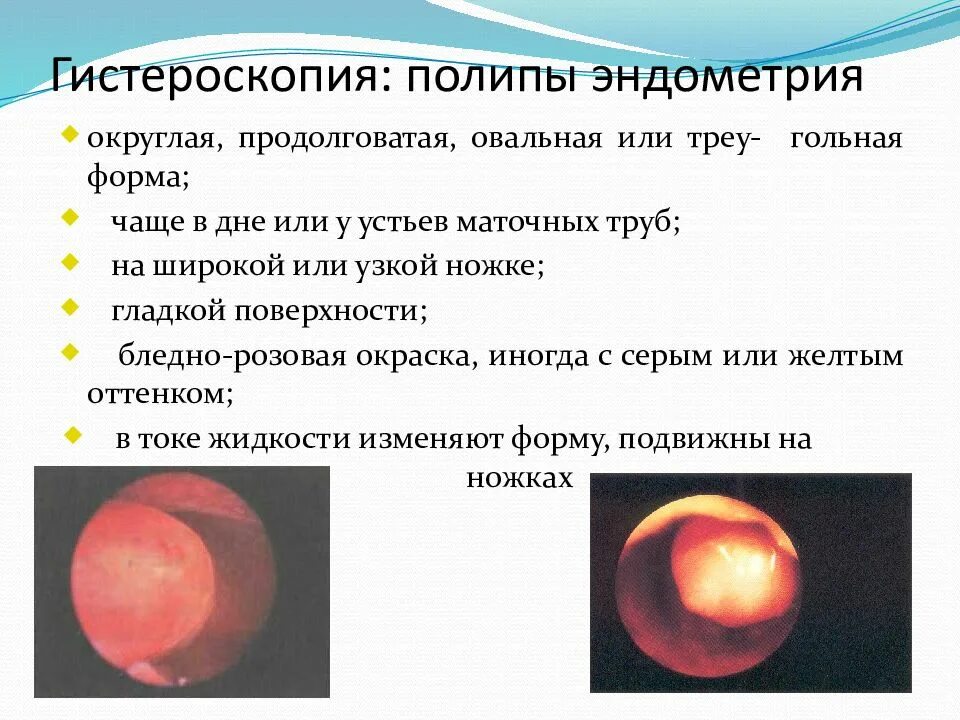 Полип как выглядит фото Полипы эндометрия в матке опасно ли