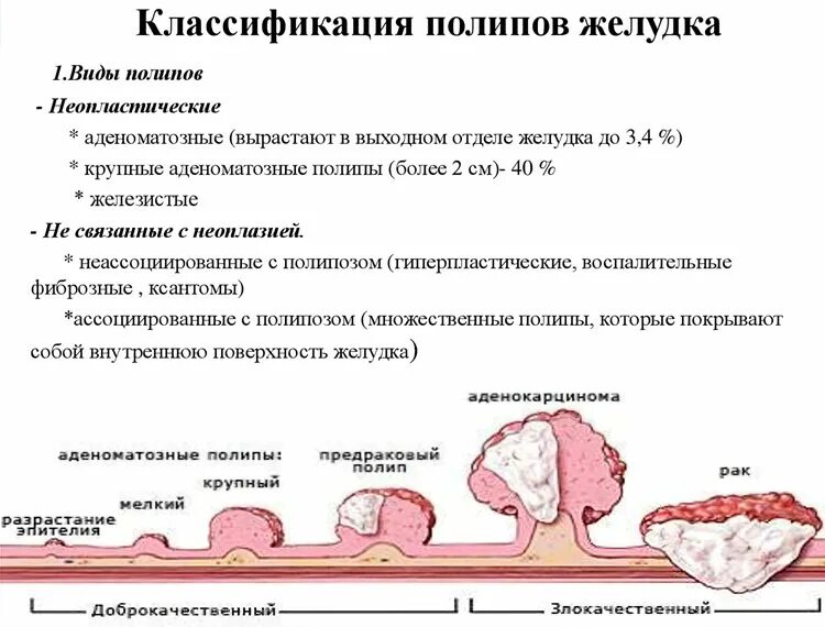 Полип как выглядит фото Полипы в желудке - опасно ли это? Симптомы и лечение