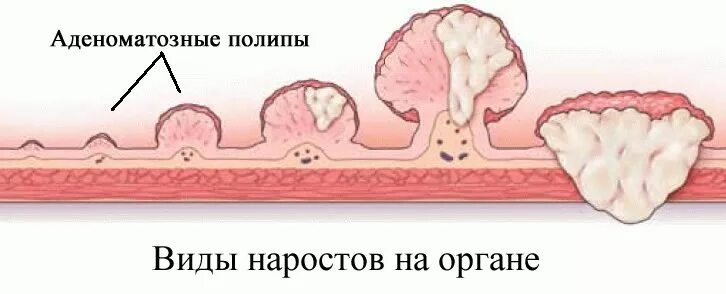 Полип как выглядит фото Аденоматозный полип желудка: причины, симптомы, диагностика и лечение