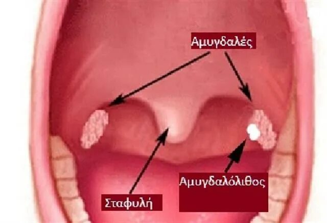 Полип на миндалине в горле фото Αμυγδαλόλιθοι Arcadia Portal