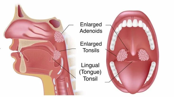 Полип на язычке в горле фото Tonsils and adenoids, Tonsil stones, Chronic sinusitis