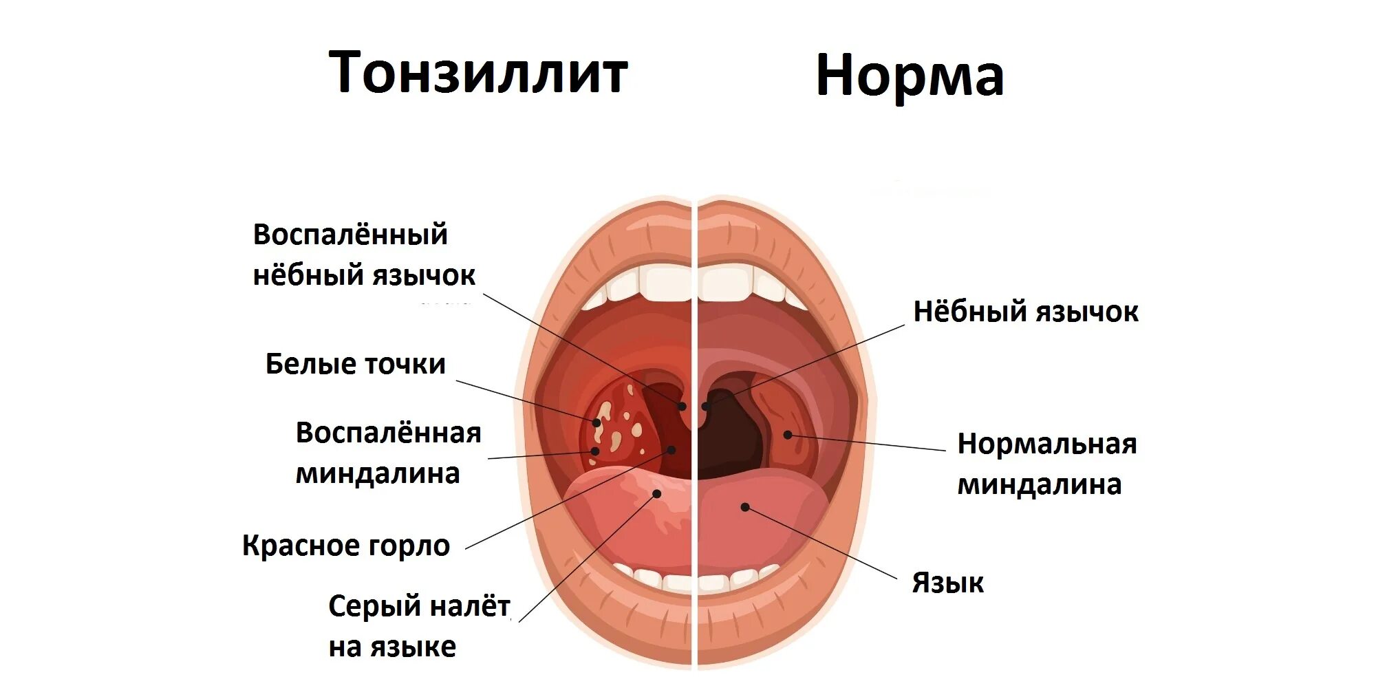 Полип на язычке в горле фото Симптомы тонзиллита / Статьи / Семейная клиника А-Медия