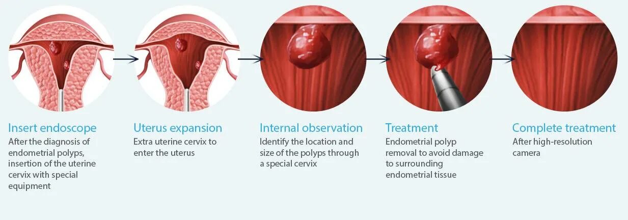 Полип уретры фото снаружи Endometrial (Uterine) Polyp: When to Remove vs. Wait, endometriosis heavy bleedi