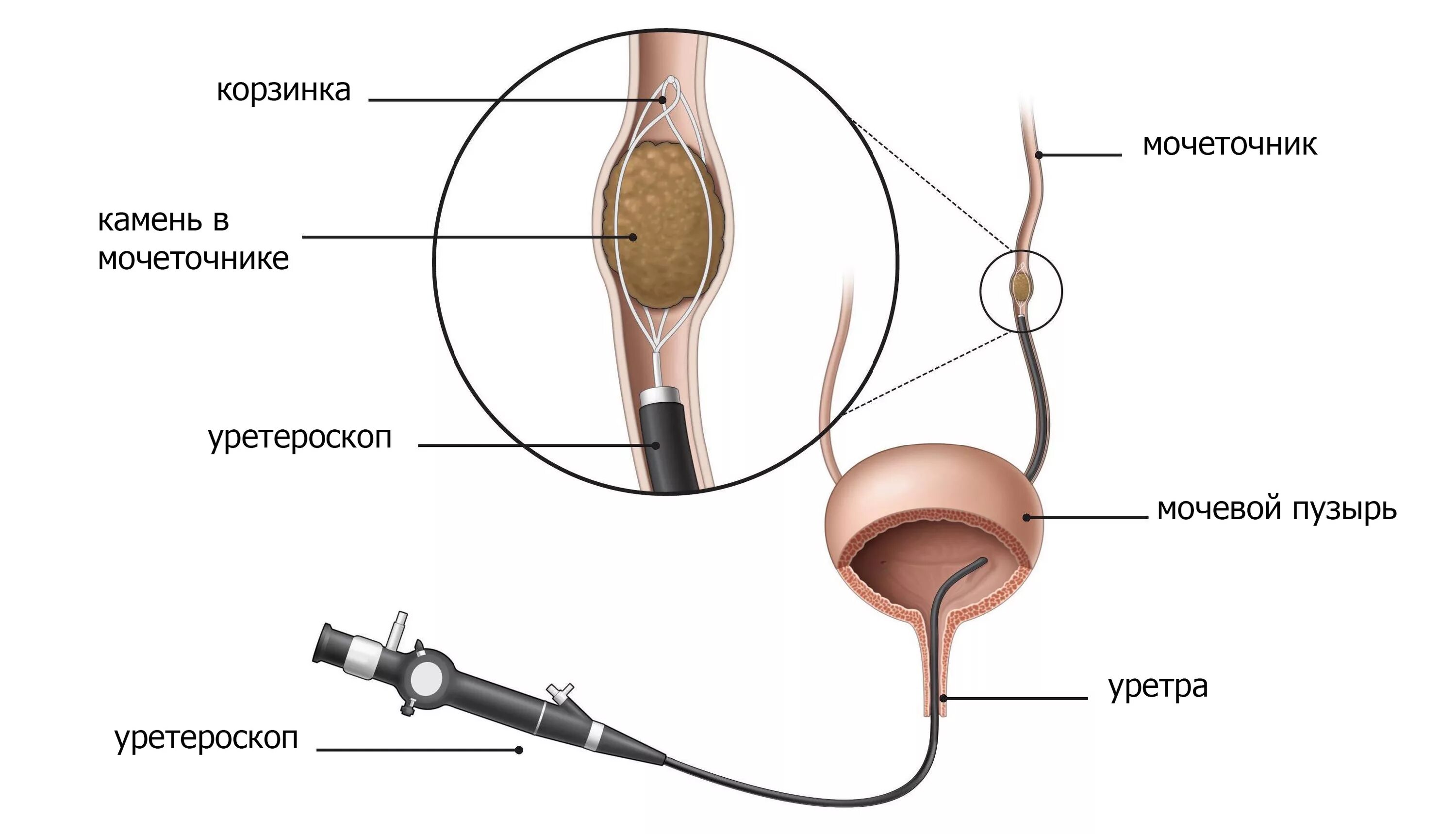 Полип уретры у женщин фото снаружи Способы дробления камней в мочевом пузыре и мочеточнике