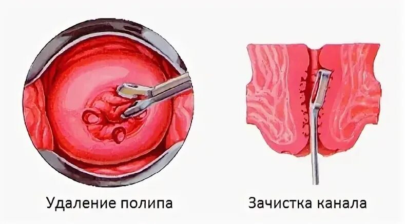 Полип уретры у женщин фото снаружи Полип шейки матки и его лечение - причины, симптомы, диагностика полипа цервикал