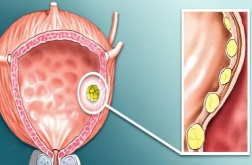 Полип уретры у женщин фото снаружи What causes polyps in the bladder in men