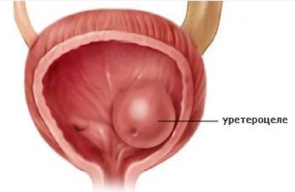 Полип уретры у женщин фото снаружи Лечение уретероцеле в Хабаровске - Медикъ