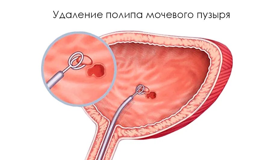 Полип уретры у женщин симптомы фото Полип мочевого пузыря - эндоскопическая операция * Русский Доктор