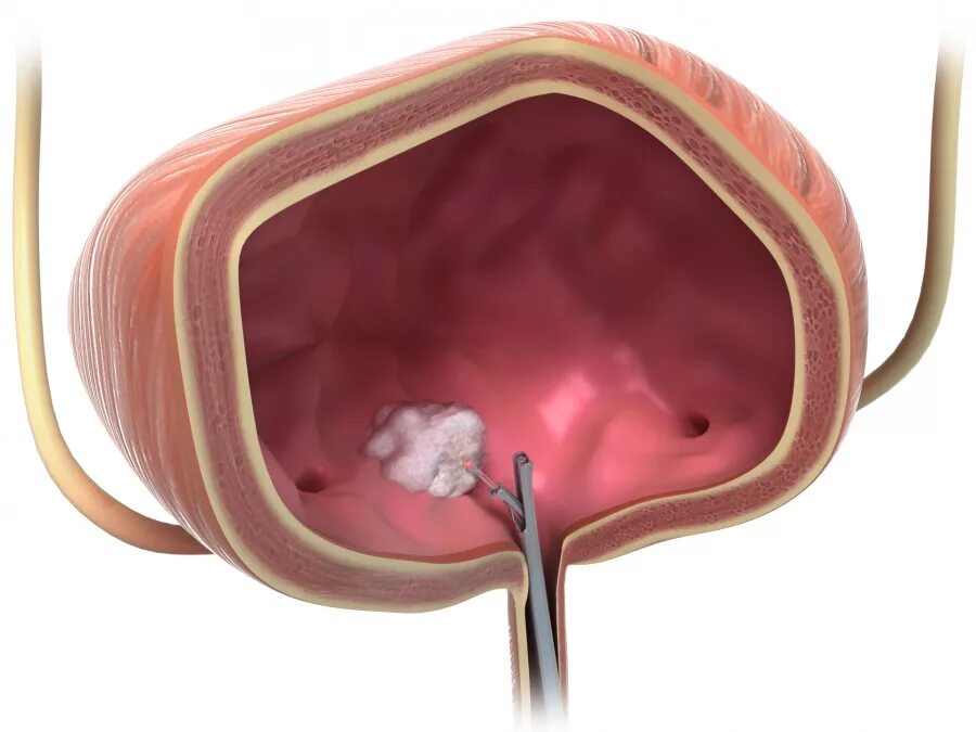 Полип уретры у женщин симптомы фото Illustration laser surgery bladder cancer - MedicalGraphics