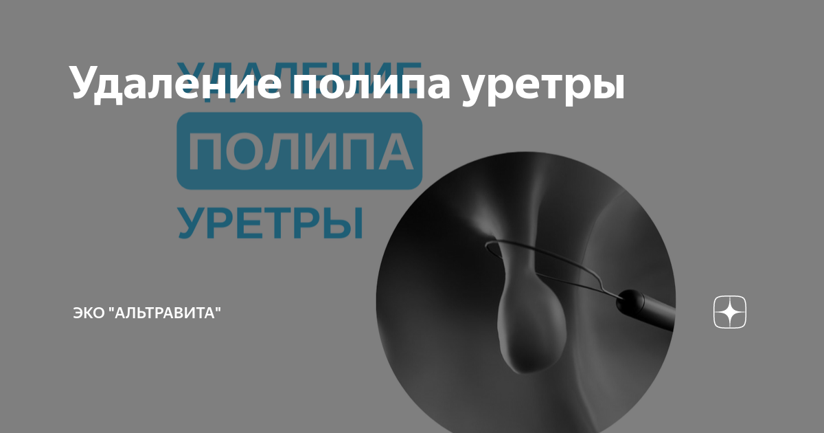 Полип уретры у женщин симптомы фото Удаление полипа уретры Клиника "АльтраВита" Дзен