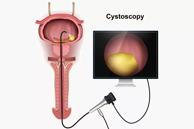 Полип уретры у женщин симптомы фото 1_male-cystoscopy fissi