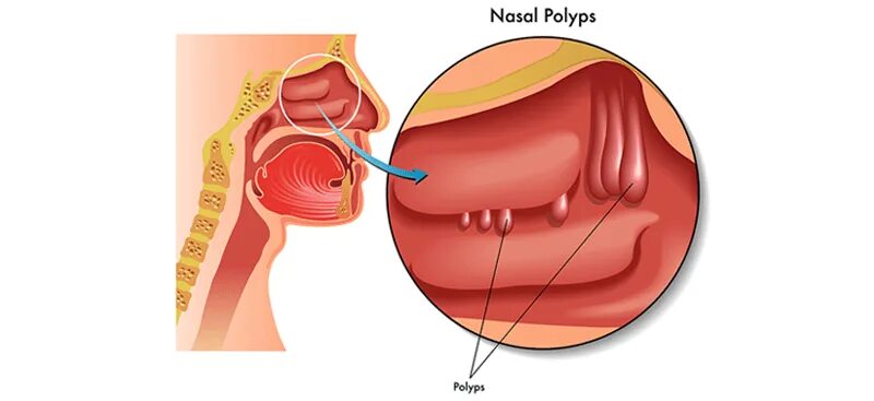 Полип в горле фото реальные nasal polyps blocked nose Cheaper Than Retail Price Buy Clothing, Accessories an