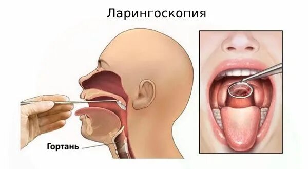 Полип в горле фото реальные Хронический ларингит: причины, симптомы и лечение в статье ЛОРа Зайцев В. М.