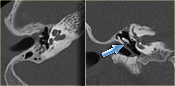 Полип в ухе фото The Radiology Assistant : Temporal Bone Pathology