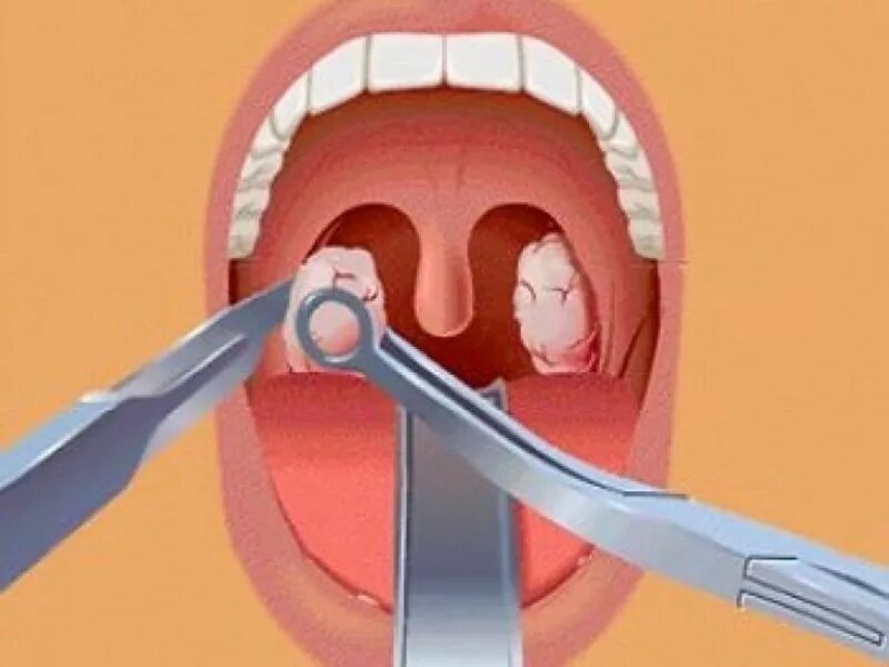 Полипы в горле фото Paratonsillar abscess in Tashkent Treatment