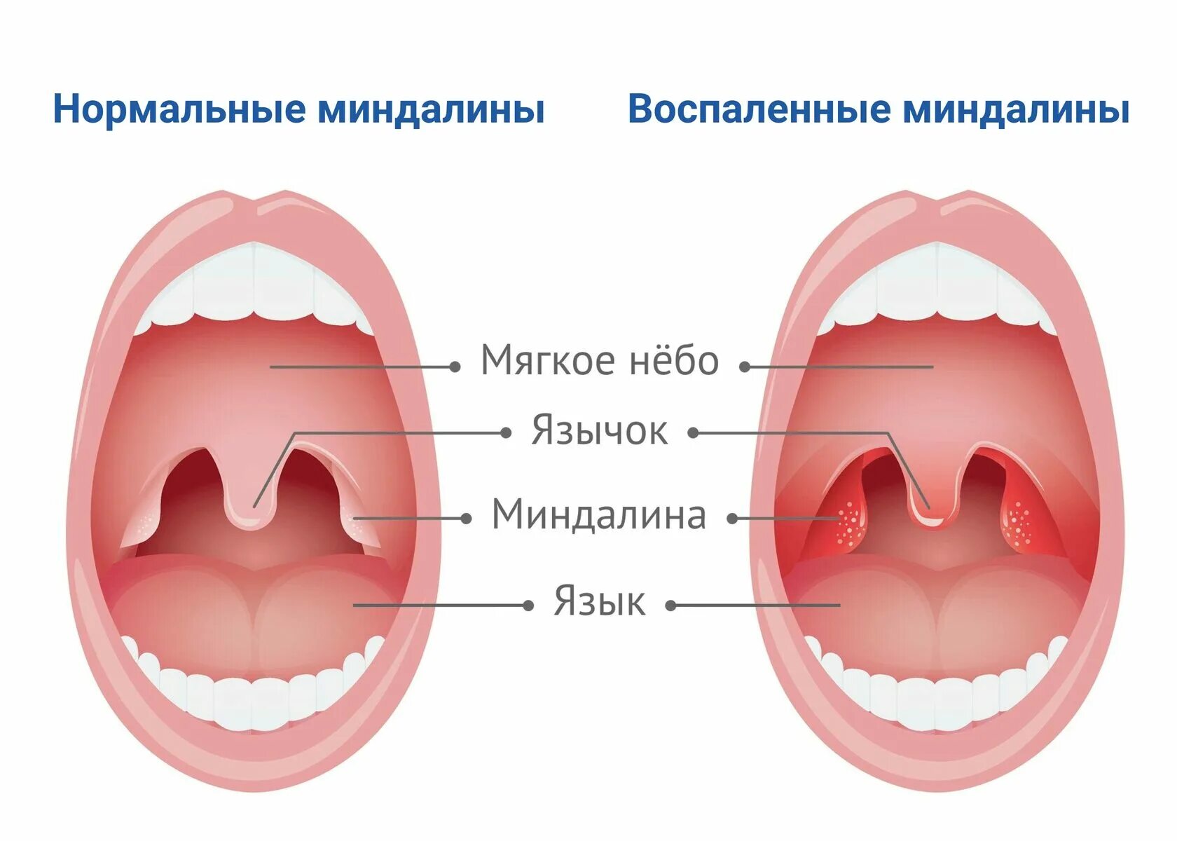 Полипы в горле фото у ребенка Лакунотомия