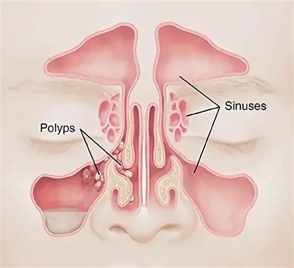 Полипы в носу симптомы фото Understanding Nasal Polyps Spectrum Health Lakeland