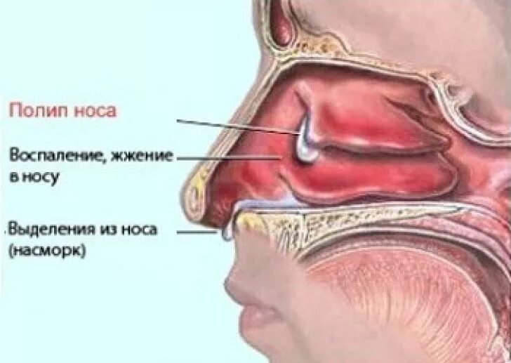 Полипы в носу симптомы фото Доброкачественные опухоли полости носа - классификация, симптомы, лечение