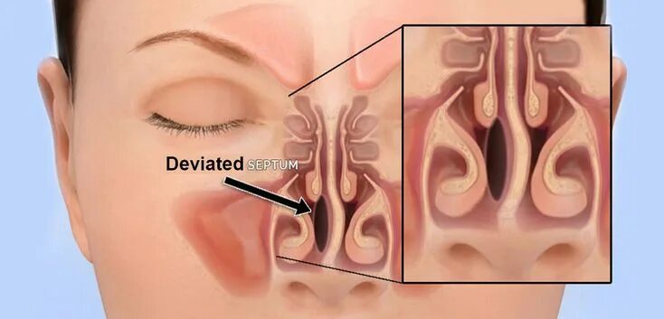 Полипы в носу симптомы фото Septum Deviasyonu Nedir?