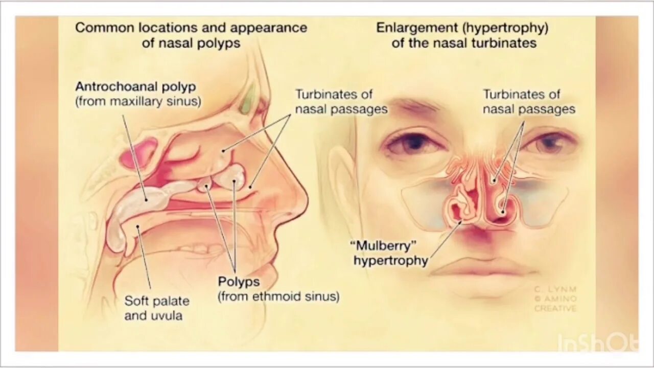 Полипы в носу симптомы фото Nasal Polyps Treatment Miracle PDF FREE Download - YouTube