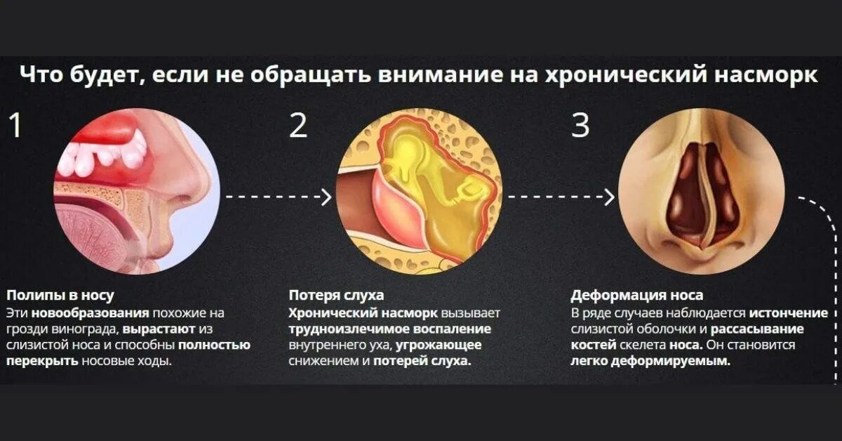 Полипы в носу симптомы фото Корки в носоглотке: найдено 30 изображений