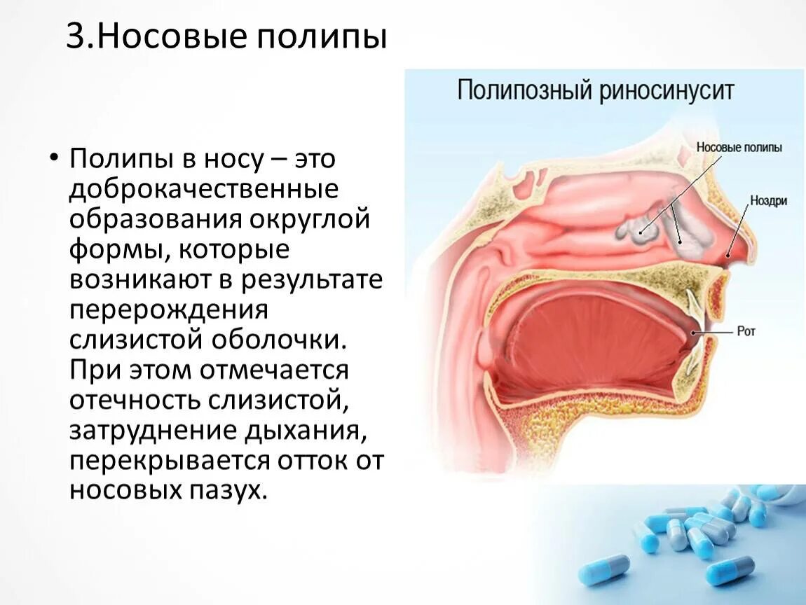 Полипы в носу симптомы фото Причины возникновения полипов в носу у ребенка, симптомы с фото и особенности ле