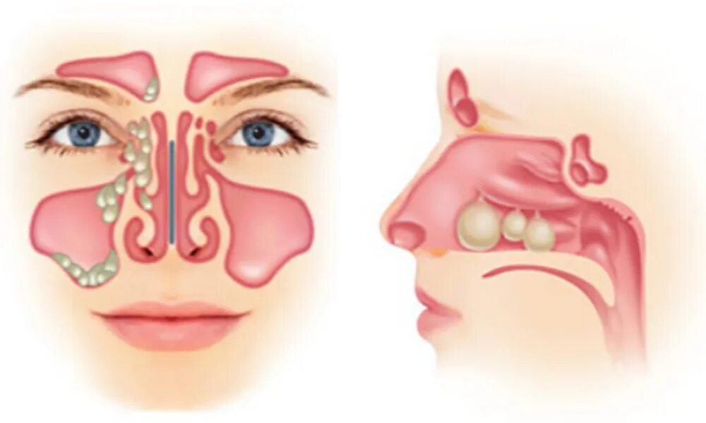 Полипы в носу симптомы фото Milia cyst on nose