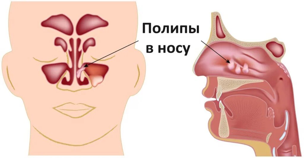 Полипы в носу симптомы фото Удаление полипа в носу (полипотомия) - цена в СПБ