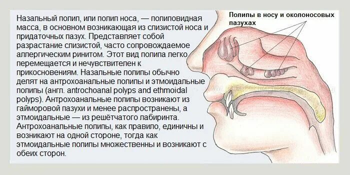 Полипы в носу симптомы фото Лечение полипов эффективными народными средствами