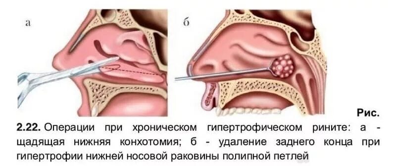 Полипы в носу симптомы фото Ринит хронический: что это за заболевание, насморк носа причины и лечение у взро