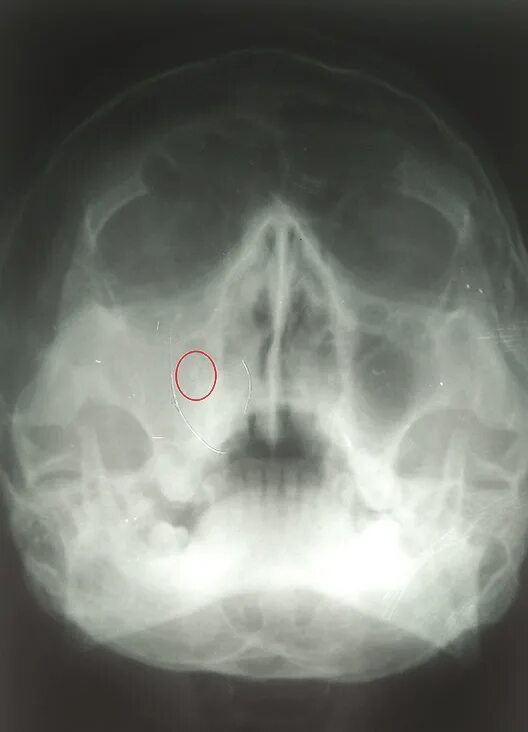 Полипы в носу симптомы фото Paranasal sinus (Waters' view) showing haziness in the right sinus Download Scie