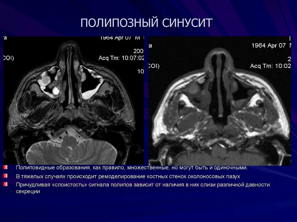 Полипы в носу симптомы у взрослых фото Картинки ПОЛИП ПАЗУХИ НА КТ