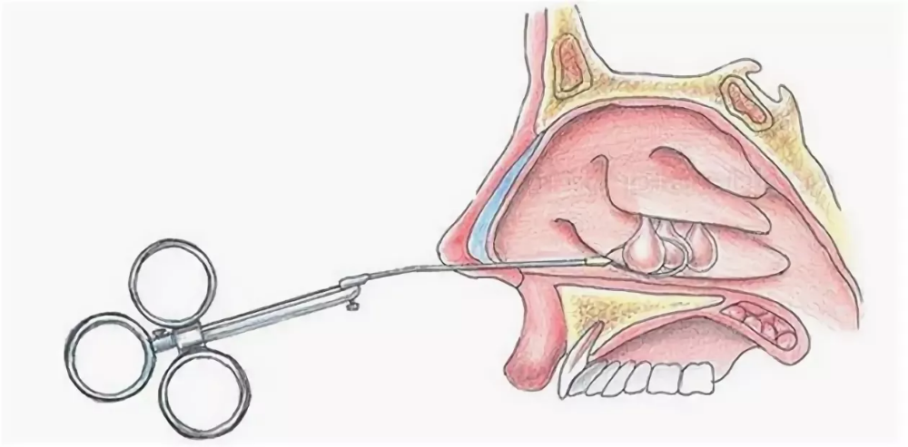 Полипы в носу симптомы у взрослых фото Стационарные операции - Эндоскопическая полипоэтмоидотомия рядом с домом - МЦ "П