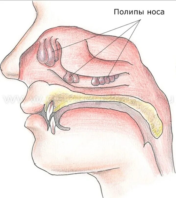 Полипы в носу симптомы у взрослых фото Самарская городская поликлиника № 6 Промышленного района Новости - Полипы носа.