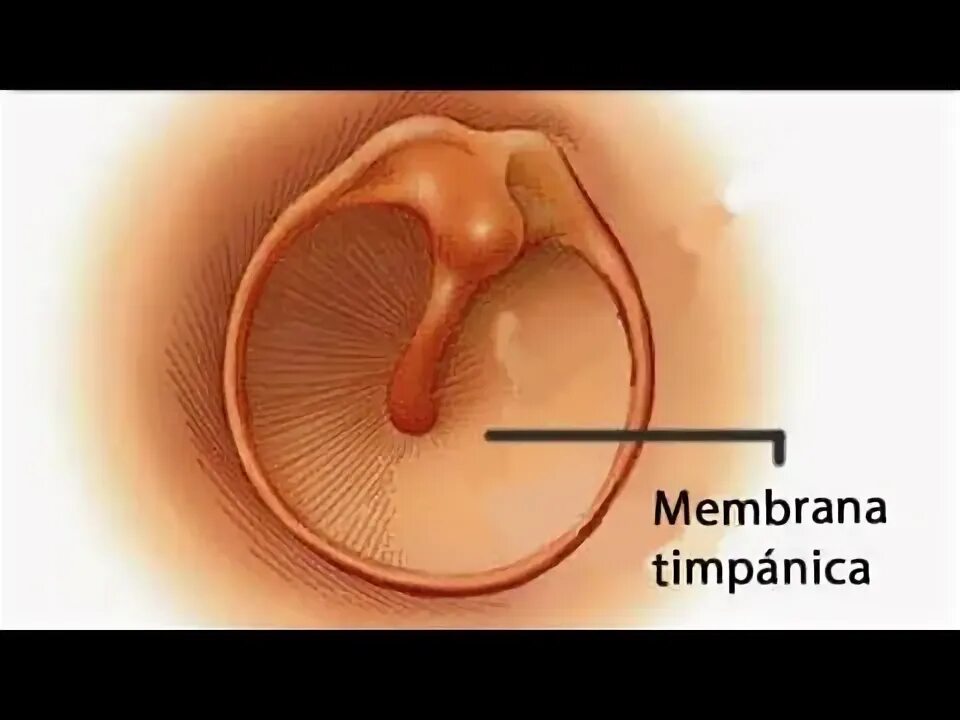 Полипы в ухе у человека фото Por qué puede estar causada una perforación timpánica? - YouTube