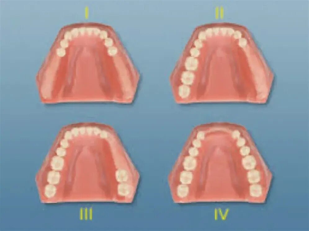 Полное отсутствие зубов фото Pin on Dental Education