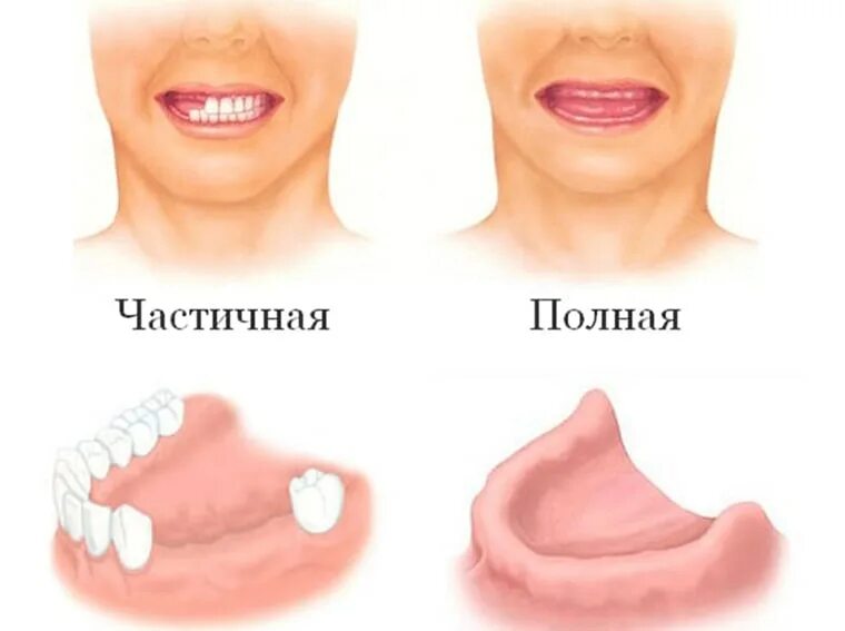 Полное отсутствие зубов фото Лучшие протезы при полном отсутствии зубов: виды, плюсы и минусы - Стоматологиче