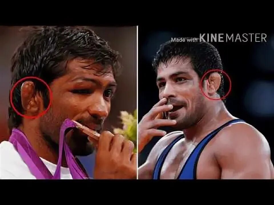 Поломанные уши фото cauliflower ear in hindi,पहलवानों के कान की समस्या,cauliflower ear drain,ear inj