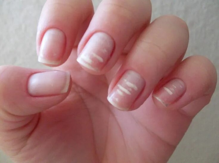 Полоски на ногтях рук фото Como evitar y tratar las manchas blancas en las uñas- White spots on nails, Whit