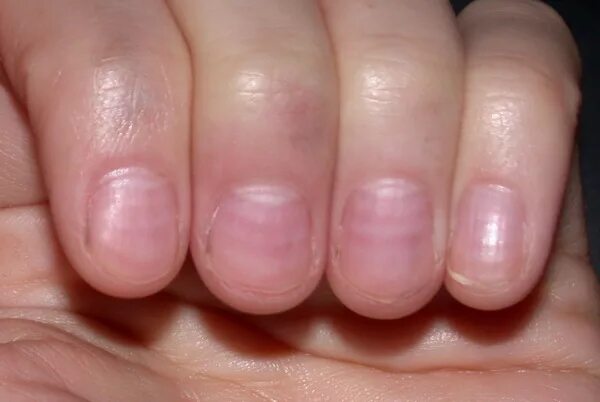 Полоски на ногтях рук фото Muehrcke's nails - Wikipedia