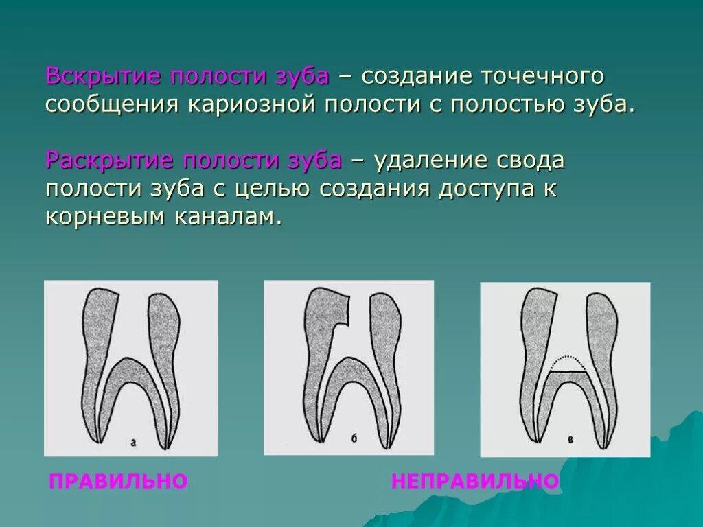 Полость зуба фото Свод полости