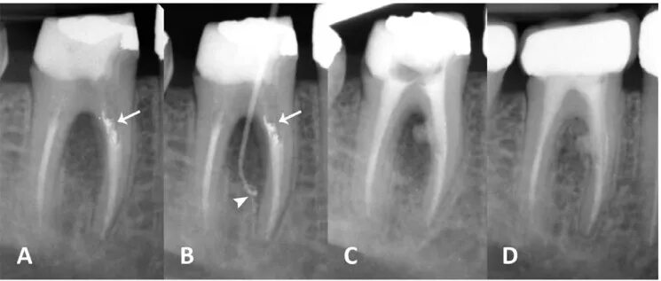 Полость зуба фото A) Pre-operative parallel radiography of the lower first molar with an... Downlo