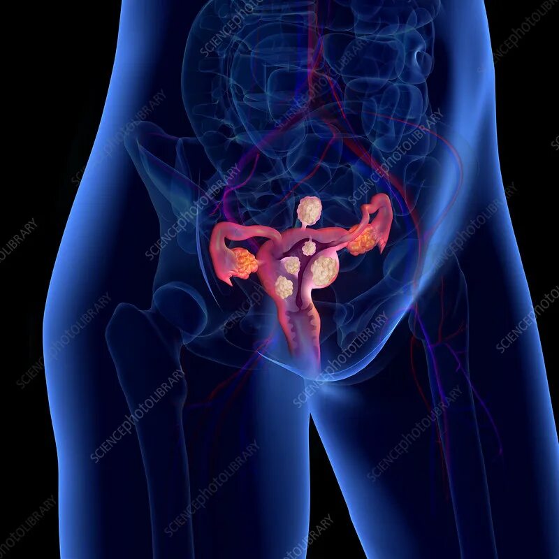 Половая система фото Uterine fibroids, illustration - Stock Image - C049/2610 - Science Photo Library