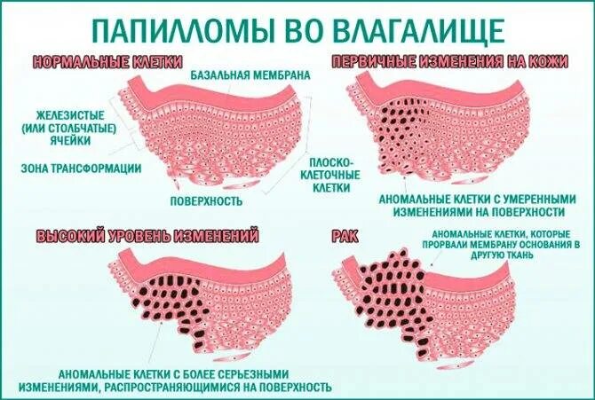 Половой генитальный герпес фото Впч 31 типа у женщин, что это такое: какие могут быть последствия, днк папиллома