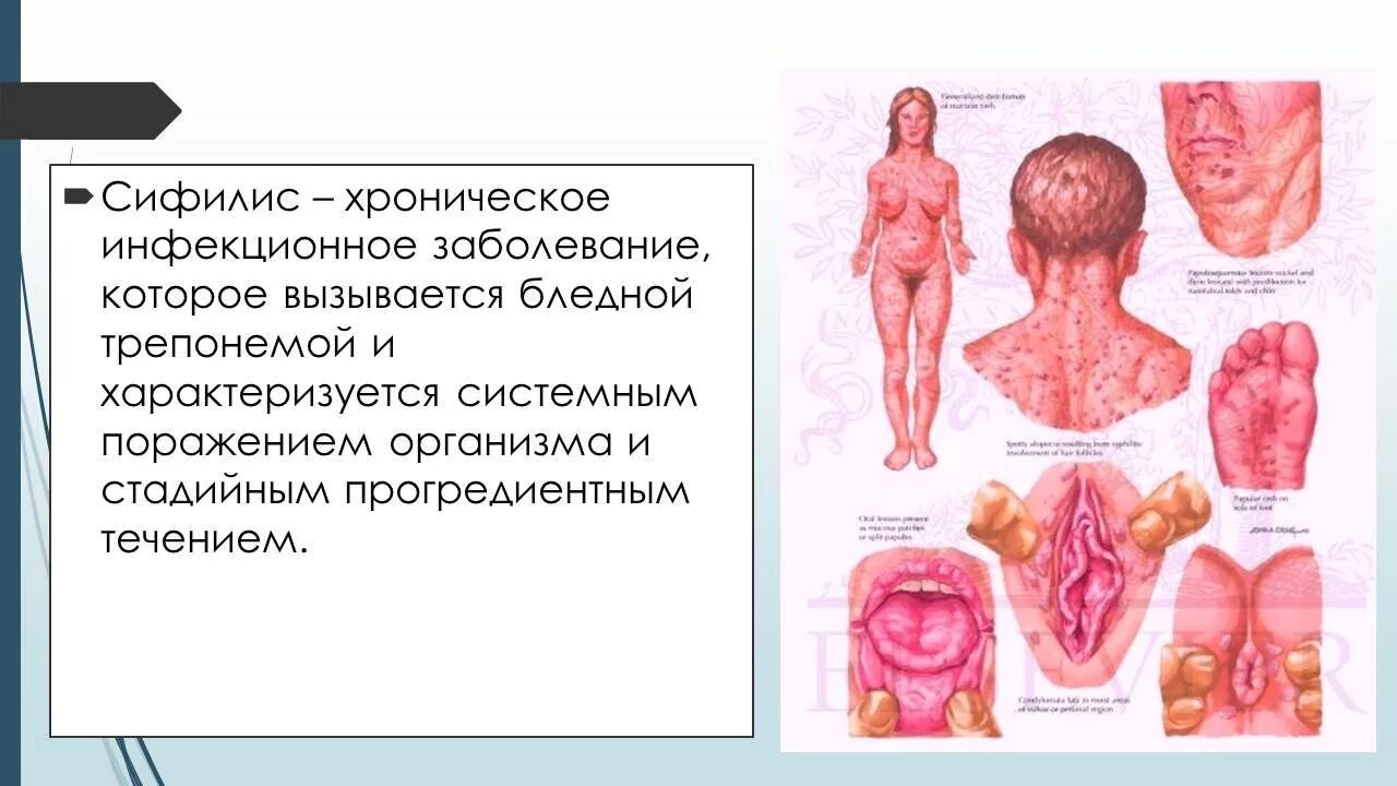 Половой генитальный герпес фото Презентация - Сифилис " Привет Студент!