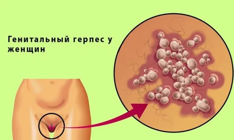 Половой генитальный герпес фото Генитальный герпес у женщин: лечение болезни