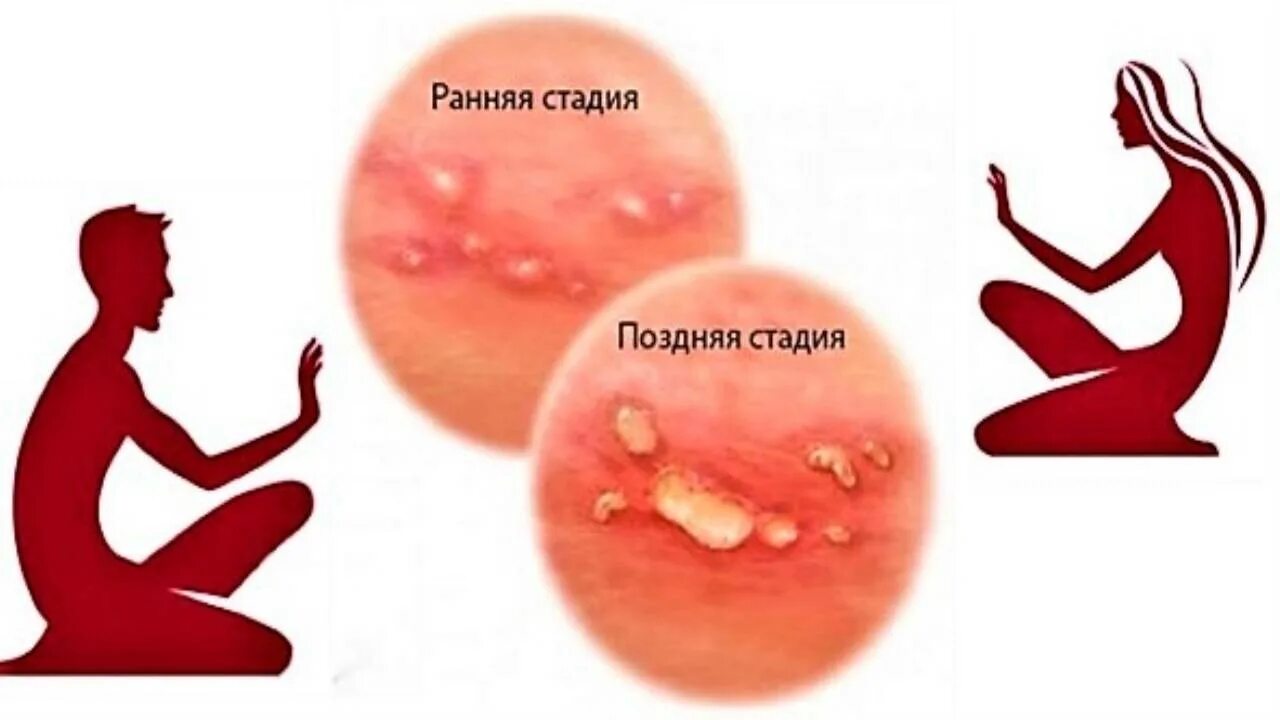 Половой герпес на головке фото Новости