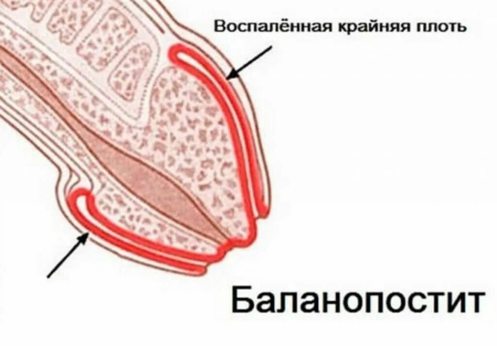 Половой герпес на головке фото Симптомы и признаки урологических заболеваний